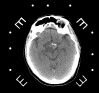 axial CT