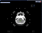 CT Biopsy