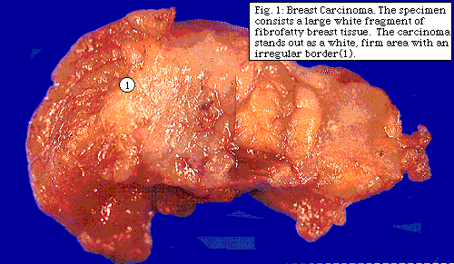 Surgical Pathology And Breast Cancers